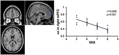 Corrigendum: Microstructural Abnormalities Were Found in Brain Gray Matter from Patients with Chronic Myofascial Pain